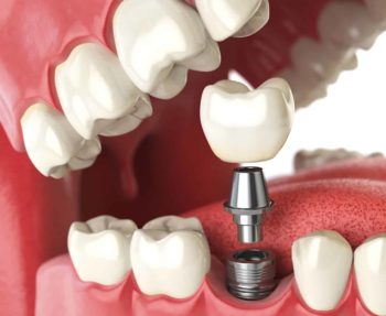 why choose dental implants?