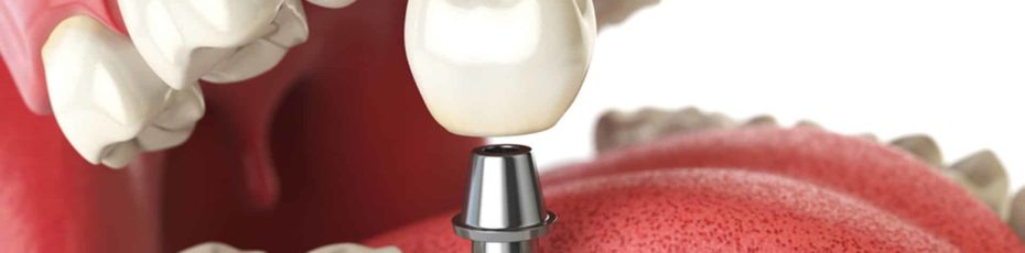 why choose dental implants?