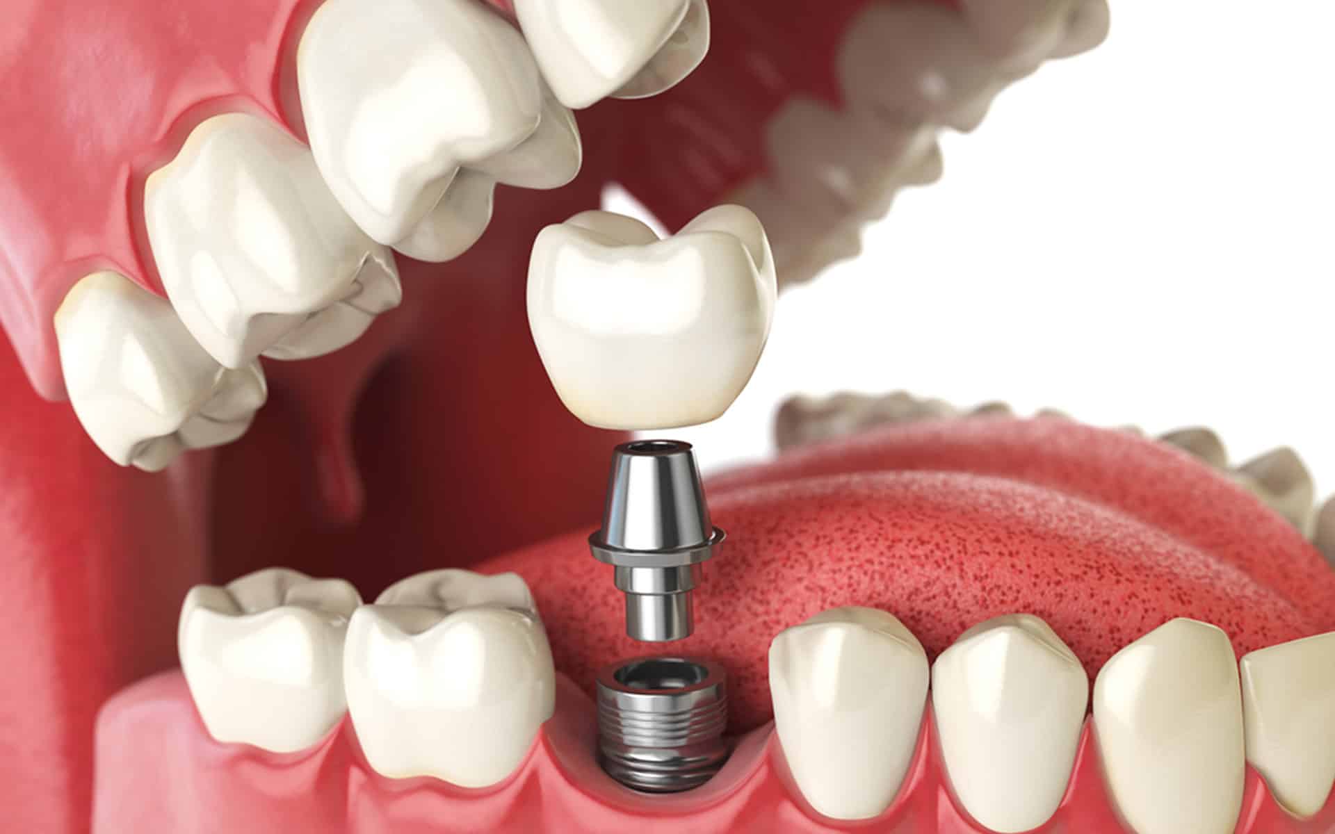 why choose dental implants?
