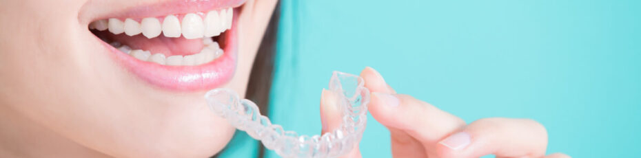 top things you should know before acquiring invisalign