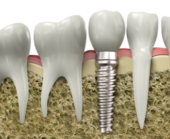 when to consider dental implants