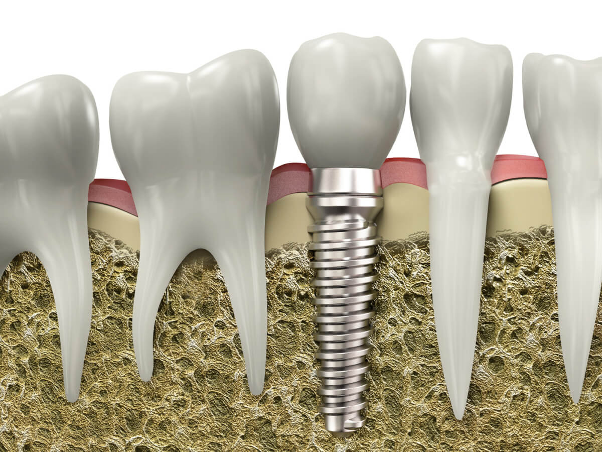 when to consider dental implants