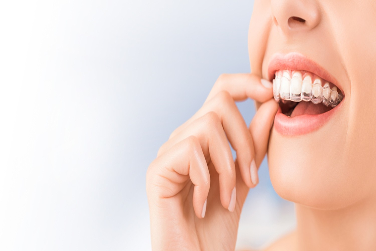 4 common invisalign problems (and how to deal with them)