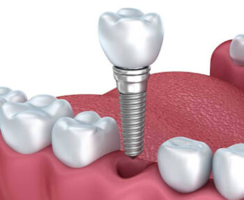 heres how to transition from dentures to dental implants