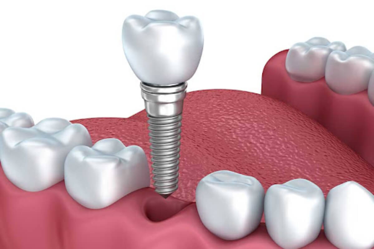 heres how to transition from dentures to dental implants