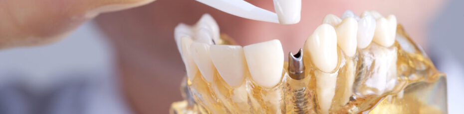 get the perfect smile with dental implants