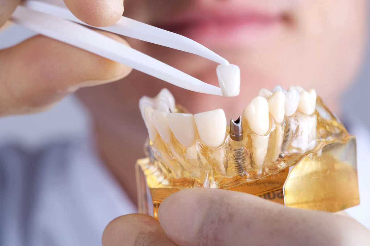 get the perfect smile with dental implants