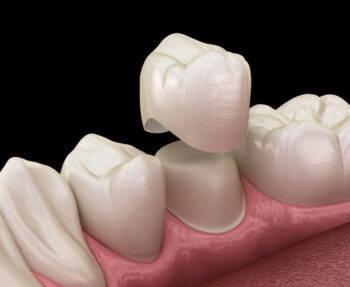 5 essential tips for caring for your ceramic crown