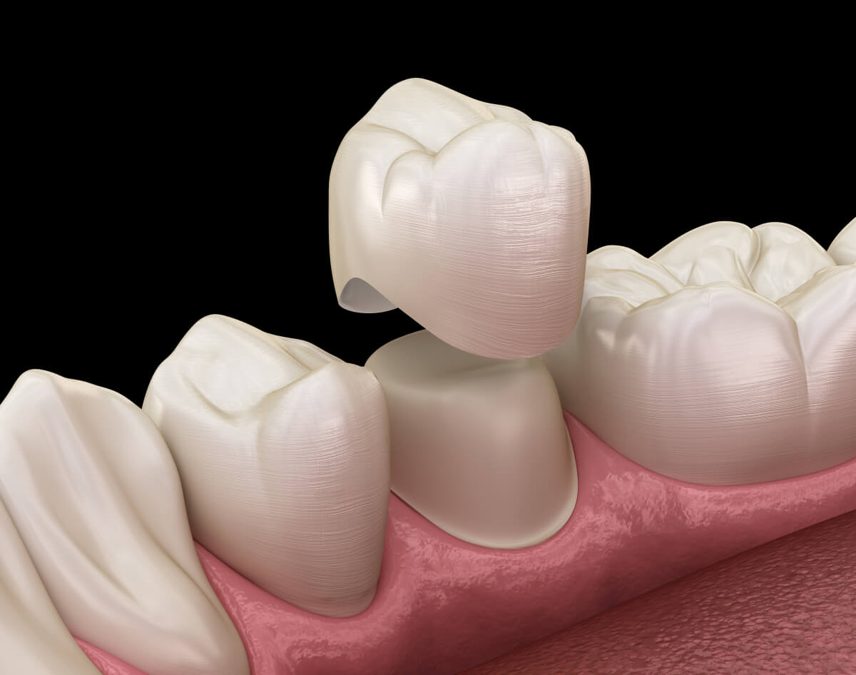 5 essential tips for caring for your ceramic crown