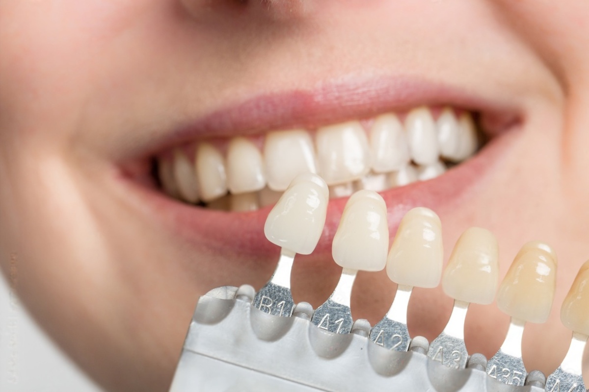 7 tips for choosing the right porcelain veneer