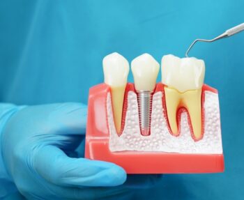 how dental implants can restore your smile and confidence