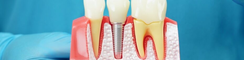 how dental implants can restore your smile and confidence