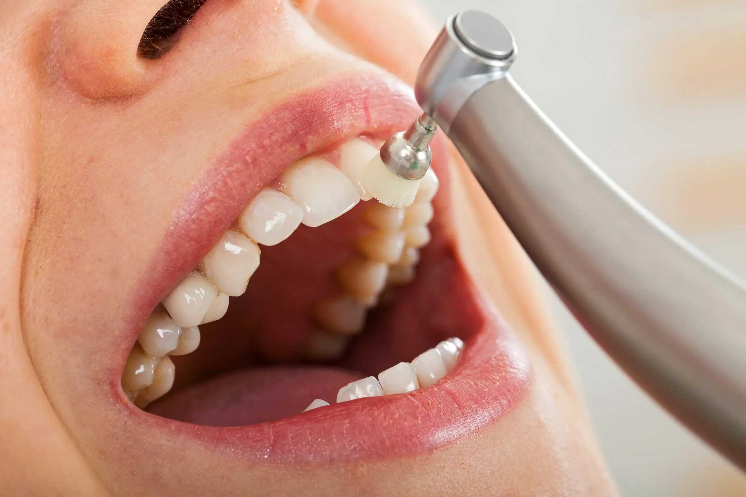 dental cleanings near me