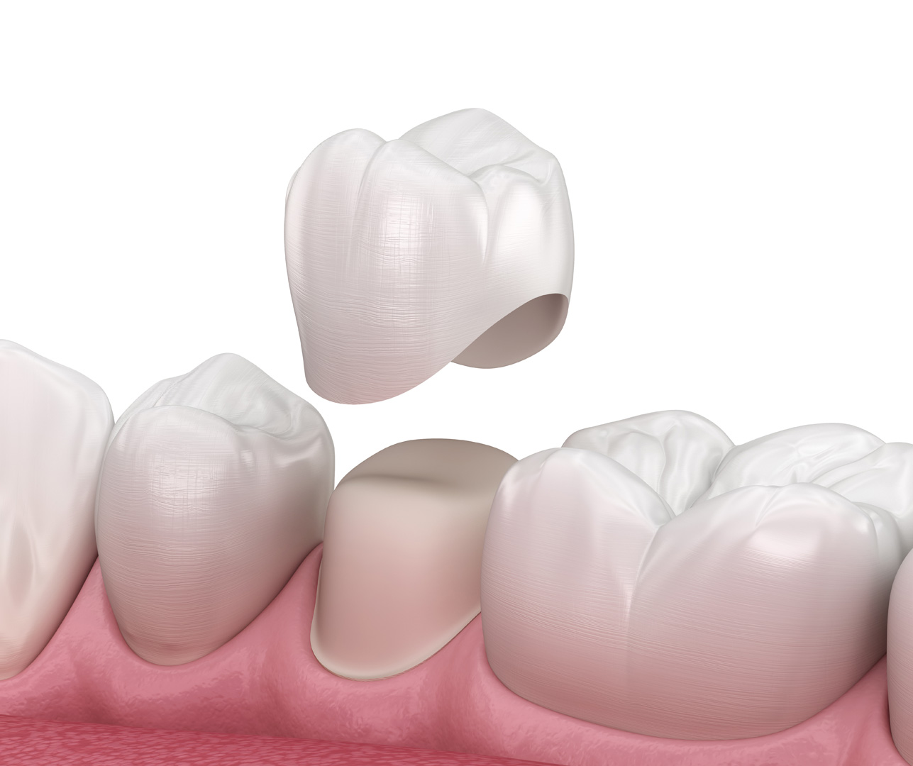 dental crowns near me