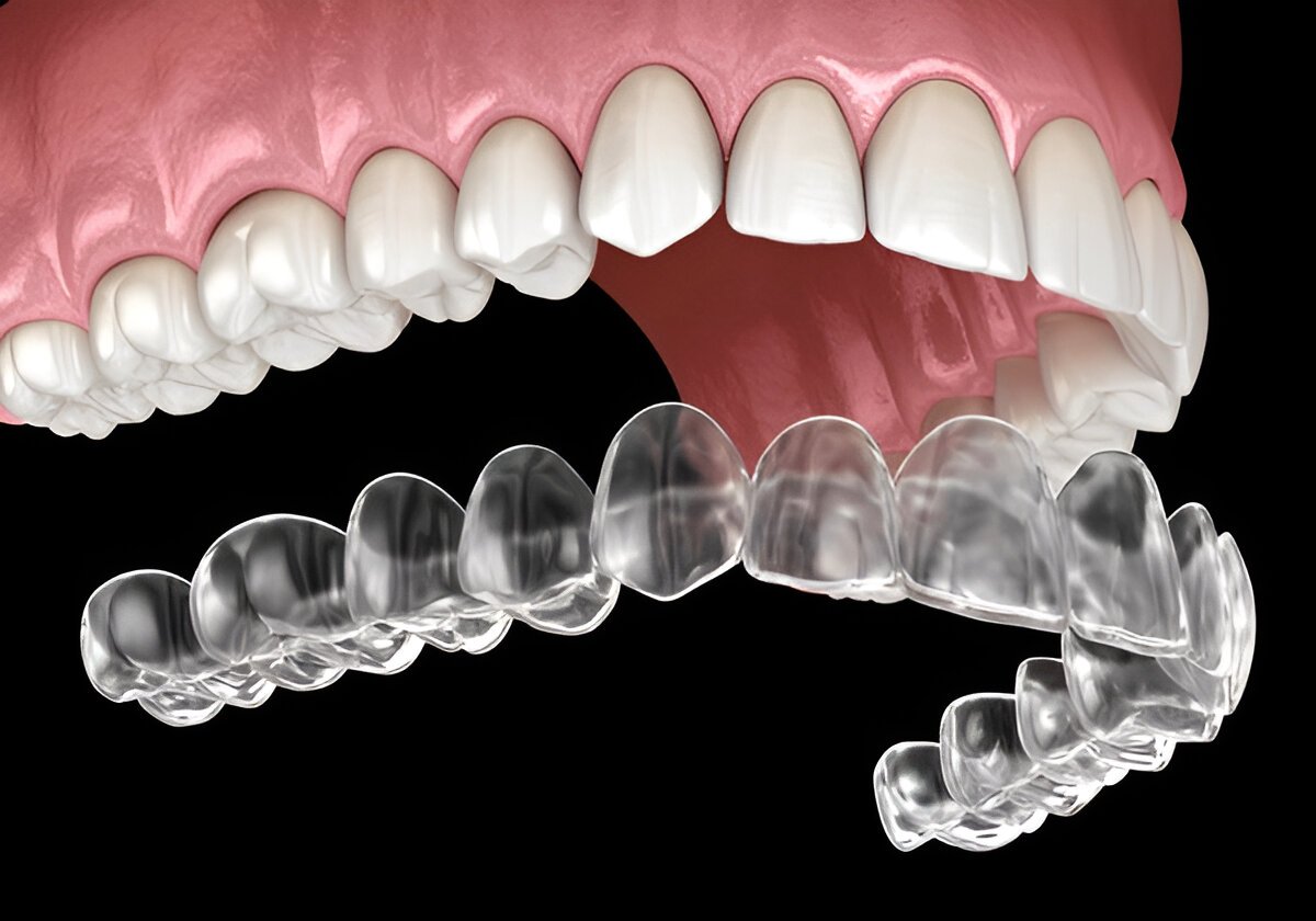 invisalign in winnipeg, mb