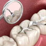 signs you may need a dental filling