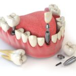 Dental implant aftercare tips for long term success
