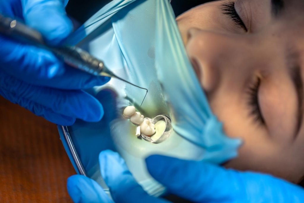 How Dental Inlays and Onlays Prevent Tooth Fractures