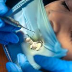 How Dental Inlays and Onlays Prevent Tooth Fractures